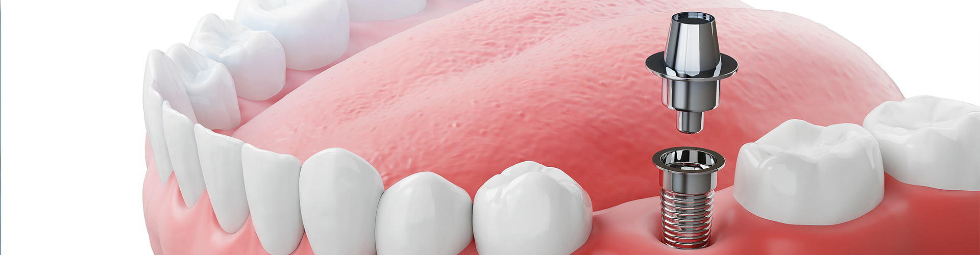 rendering of a crown above an abutment above an implant going in the gum